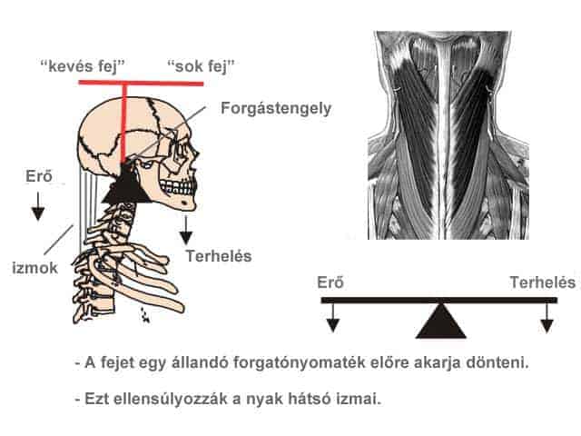 Mit jelent a nyaki gerinc eredetű fejfájás?